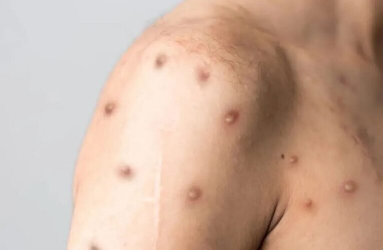 Primeiro caso de mpox em 2026 na região Centro-Oeste de Minas Gerais é confirmado em Formiga: a vigilância em saúde em foco